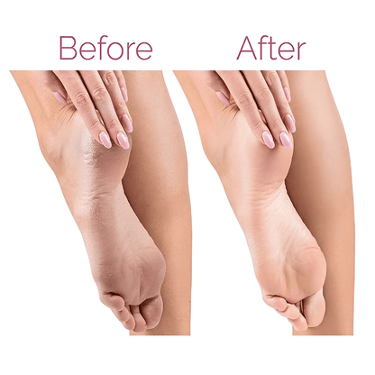 Electric Pedicure Foot File | Rechargeable Callus Remover for Smooth Feet